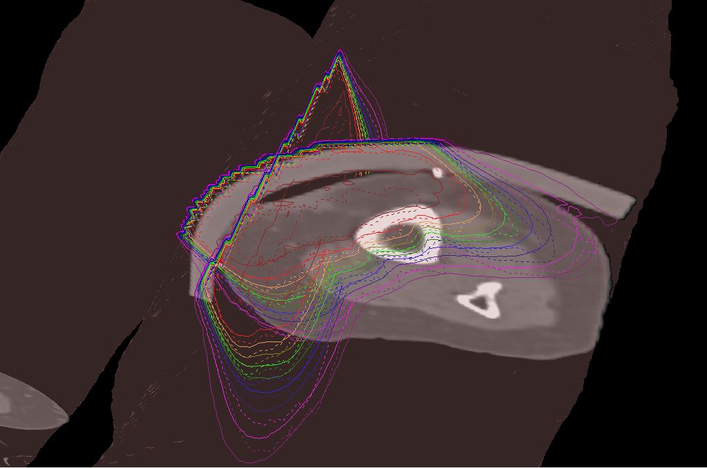 Electron Isodose